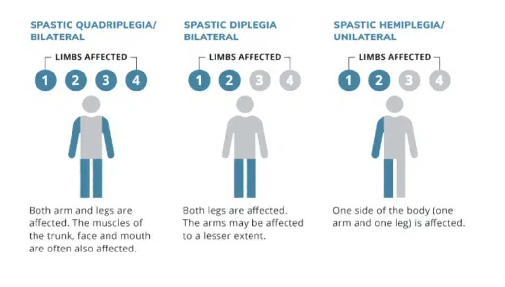 Types of spastic cerebral palsy
