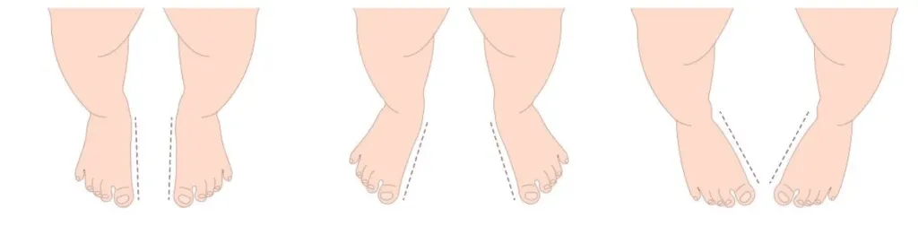 Normal, out-toeing and in-toeing illustration